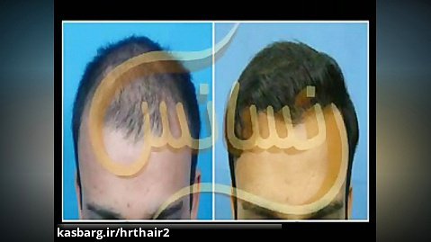 کاشت مو به روش SUT مرکز تخصصی مو رنسانس