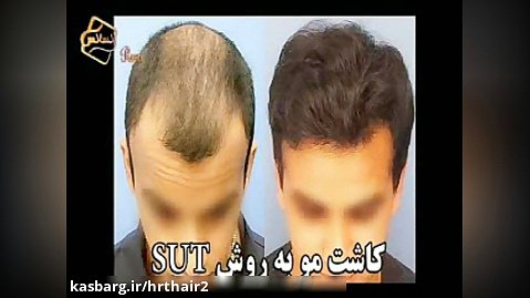 کاشت مو به روش SUT مرکز تخصصی مو رنسانس