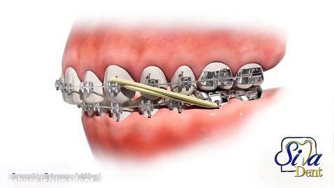 کش ارتودنسی | دندانپزشکی سیمادنت