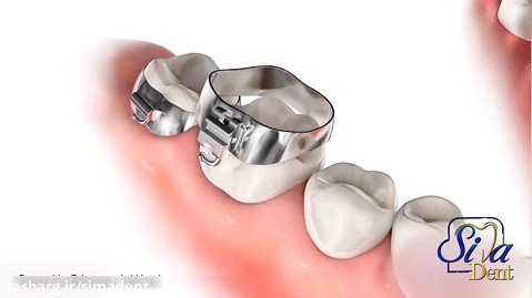 بند ارتودنسی | دندانپزشکی سیمادنت
