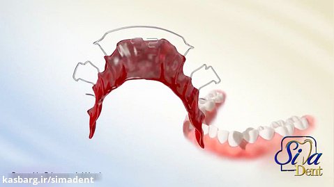 پلاک ارتودنسی | دندانپزشکی سیمادنت