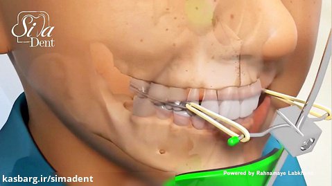 فیس ماسک ارتودنسی | دندانپزشکی سیمادنت