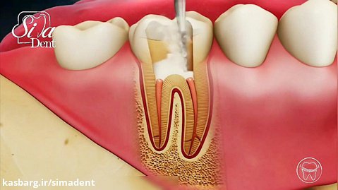 پست و کور دندان | دندانپزشکی سیمادنت