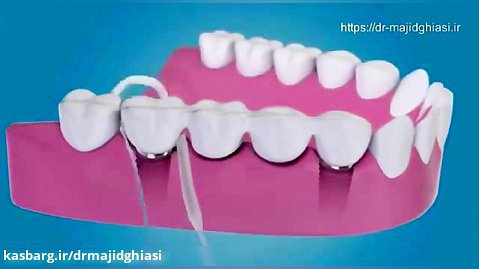 ایمپلنت دندان-بهداشت ایمپلنت دندانی
