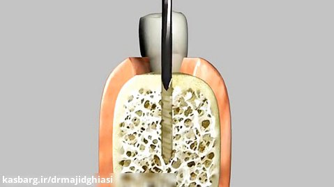 مراحل ایمپلنت دندان -دکترمجیدقیاسی -زراعه الاسنان