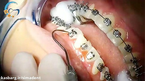 ارتودنسی دیمون بدون کشیدن دندان | دندانپزشکی سیمادنت