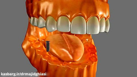 ایمپلنت دندان -دکترمجید قیاسی جراح ودندانپزشک