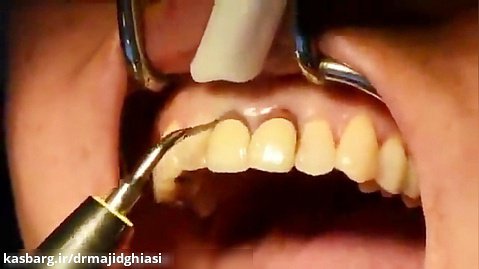 ایمپلنت دندان-دکترمجیدقیاسی جراح ودندانپزشک