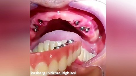 ایمپلنت دندانی-دکترمجیدقیاسی جراح ودندانپزشک زیبایی