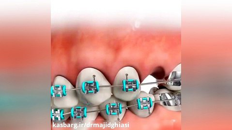 مراحل ارتودنسی دندان-دکترمجیدقیاسی بهترین دندانپزشک زیبایی