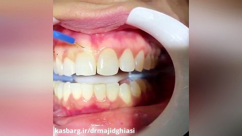 لبخند زیبا-دکترمجیدقیاسی دندانپزشک زیبایی درمشهد