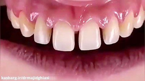 لمینت دندان-دکترمجیدقیاسی دندانپزشک زیبایی مشهد