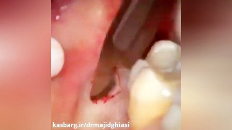 ایمپلنت دندان-دکترمجیدقیاسی دندانپزشک زیبایی مشهد
