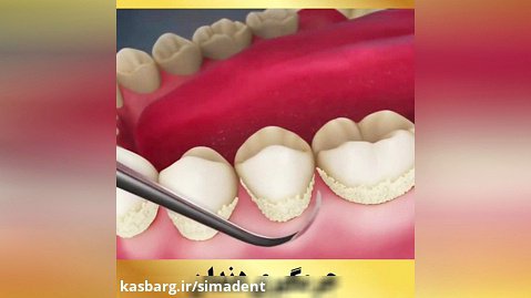 جرمگیری دندان | کلینیک دندانپزشکی سیمادنت