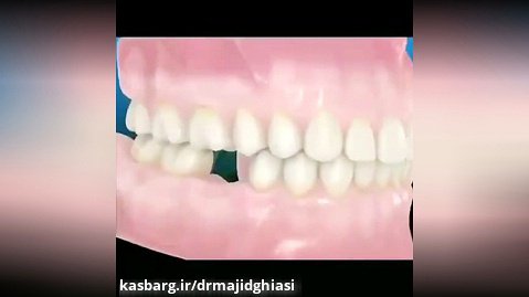 بهم ریختگی دندانها -دکترمجیدقیاسی دندانپزشک زیبایی مشهد