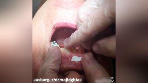 لمینت دندان -دکترمجیدقیاسی دندانپزشک زیبایی مشهد
