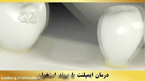 درمان ایمپلنت با پیوند استخوان | دندانپزشکی سیمادنت