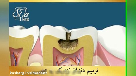 ترمیم دندان نزدیک به عصب | دندانپزشکی سیمادنت