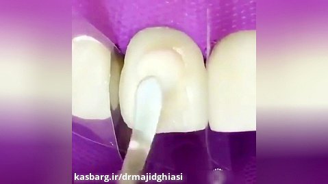 لمینت دندان-دکترمجیدقیاسی دندانپزشک زیبایی مشهد