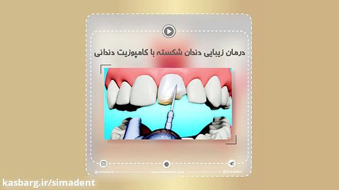 درمان زیبایی دندان شکسته با کامپوزیت دندانی