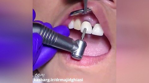 مراحل حذف ونیر قدیمی دندان و جایگزینی با ایمپلنت