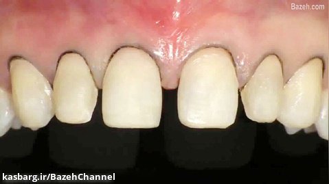 کارهای مقدماتی در دندانپزشکی زیبایی ترمیمی