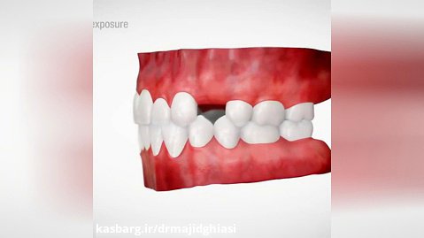 مراحل ایمپلنت دندان -دکترمجیدقیاسی دندانپزشک زیبایی مشهد