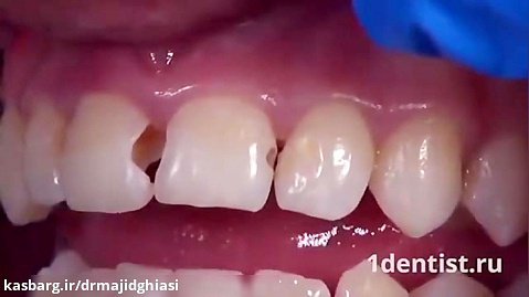 ترمیم پوسیدگی دندان-دکترمجیدقیاسی-دندانپزشک زیبایی مشهد