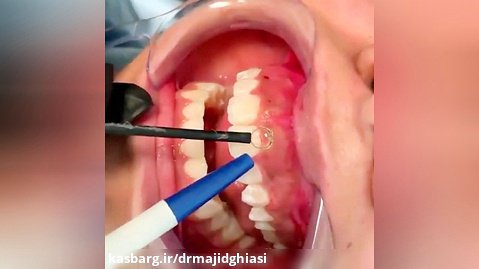 اصلاح طرح لبخند-دکترمجیدقیاسی-دندانپزشک زیبایی مشهد