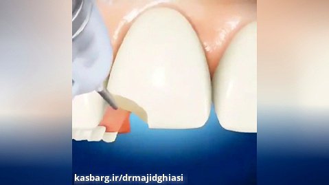 ترمیم شکستگی دندان-دکترمجیدقیاسی دندانپزشک زیبایی مشهد