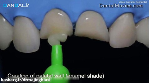 ترمیم مستقیم دندان قدامی - مرحله به مرحله