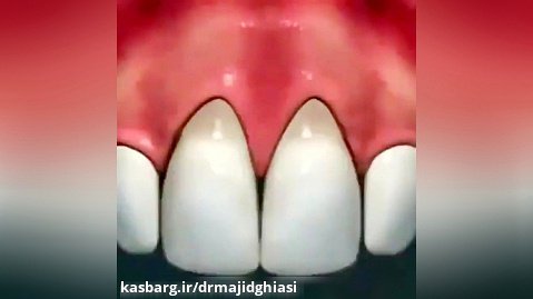 اصلاح طرح لبخند-دکترمجیدقیاسی دندانپزشک زیبایی مشهد