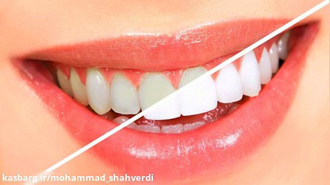 روش های سفید وصدفی  کردن دندان ها