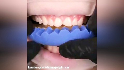 ونیر دندانی-دکترمجیدقیاسی دندانپزشک زیبایی مشهد