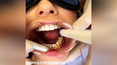 برداشت ونیر دندانی قدیمی با لیزر-دکترمجیدقیاسی-دندانپزشک زیبایی مشهد