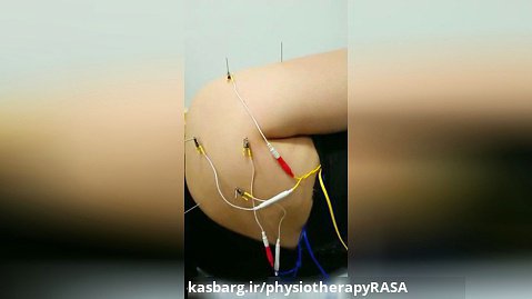 درمان شانه درد با تکنیک الکترو اکوپانچر(طب سوزنی الکتریکی)