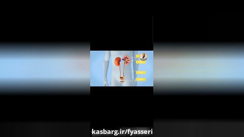 انیمیشن کوتاه عمل جراحی کلیه از راه پوست به همراه توضیحات دکتر یاسری