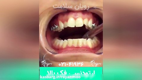 فیلم ارتودنسی دندان فک بالا در کلینیک دندانپزشکی رویان سلامت