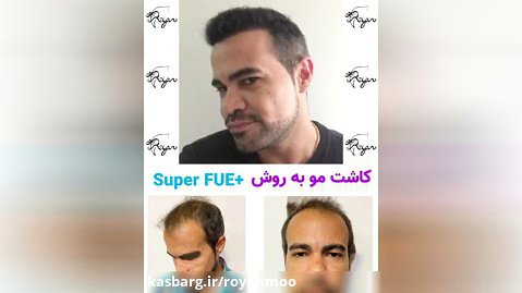 نتایج قبل و بعد از کاشت مو به روش SuperFUE