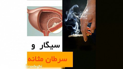 سیگار و سرطان مثانه - دکتر سید امین میرصادقی