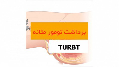 برداشت تومور مثانه (TURBT) - دکتر سید امین میر صادقی