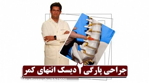 جراحی پارگی 2 دیسک انتهای کمر | دکتر علیرضا شیخی | جراح مغزواعصاب و ستون فقرات